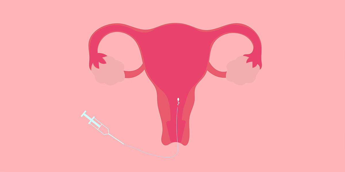 What is IUI? A complete overview
