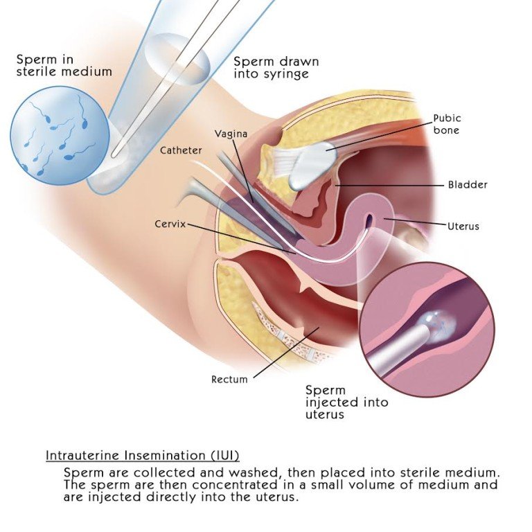 IMSI – Overcome Infertility And Build Your Family